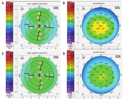 measurement of the thickness of the cornea is known as|central corneal thickness chart.